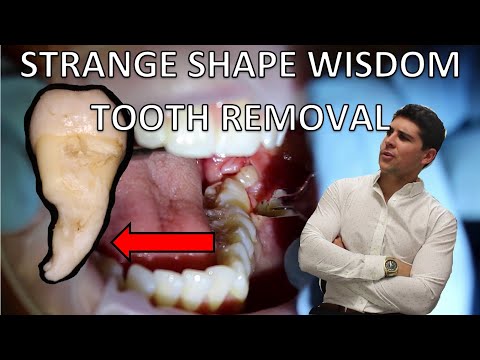Lower Partially Erupted Wisdom Tooth Removal (Full Procedure Of Extraction And Explanation)