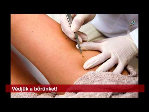furunculosis paraziták strongyloidosis ESR normál