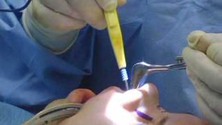Rhinoplasty Operating Room Footage – Turbinate Reduction (Nose Job)