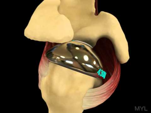 Shoulder motion; force couple after arthroplasty