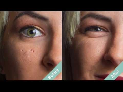 How to Cover Acne Scars with a Hollywood Secret