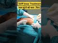 Stiff Knee जाम घुटने का Full मूवमेंट करा दिया Surger
