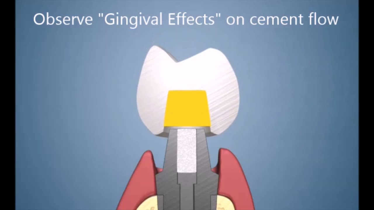 Gingival Effects on Intra oral Prosthesis Cementation