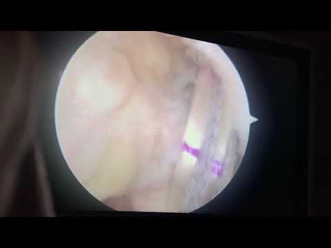 My Fibertape ACL Surgery! 6 months down the line im back playing for India! Thank you Dr Manit Arora