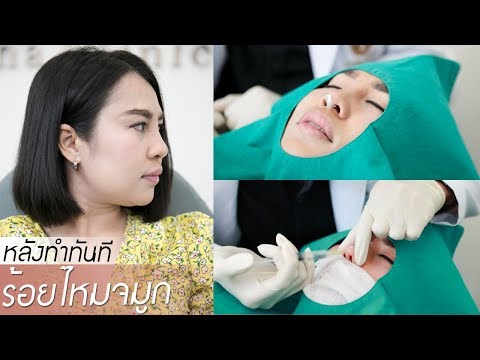 ร้อยไหม