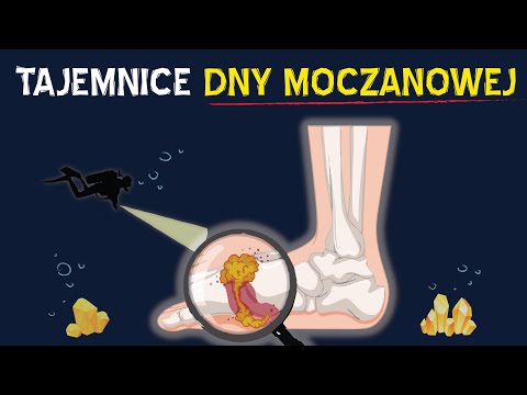 KWAS MOCZOWY a dna moczanowa i bóle stawów — skąd się biorą i jak im zapobiegać?