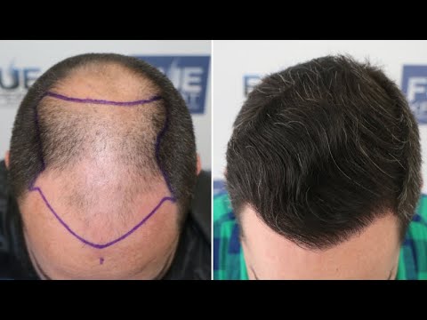 FUE Hair Transplant (4766 Grafts NW V) By Dr Juan...