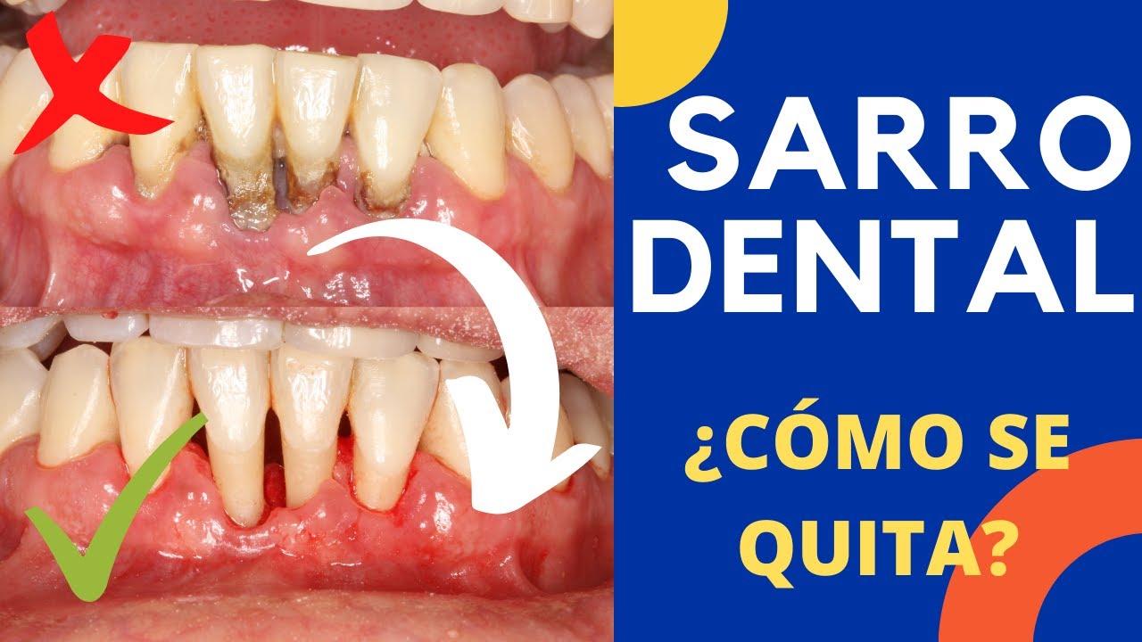 Watch Cómo se QUITA el SARRO DENTAL de los DIENTES - Tártaro | Cálculo dental - Tratamiento real Now Cómo se QUITA el SARRO DENTAL de los DIENTES - Tártaro | Cálculo dental - Tratamiento real