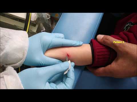 Leishmania sampling: How to take a sample from a patient with a cutaneous ulcer for leishmania test