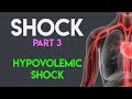 Hypovolemic Shock Shock Part 3