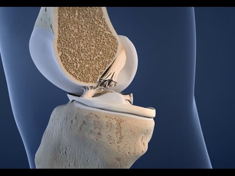 Kreuzbandriss   Medizinische 3D Animation