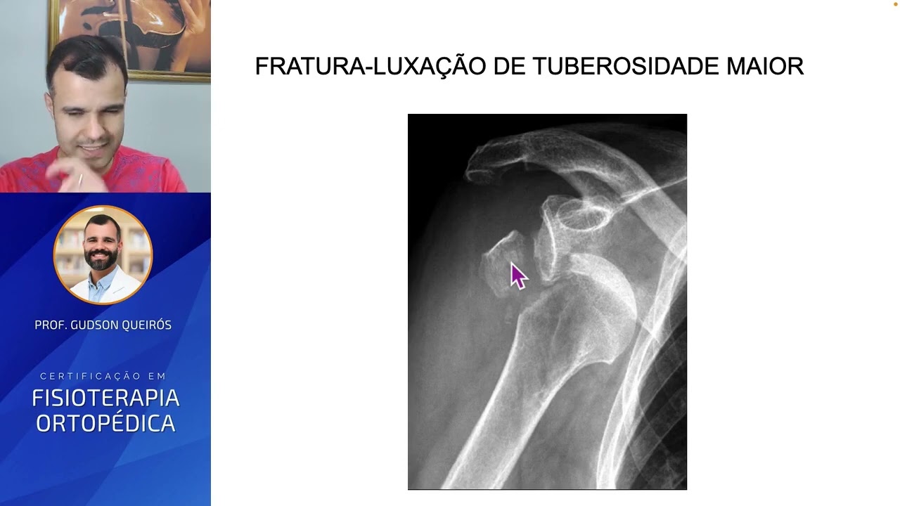 Fratura de Úmero Proximal - Da Lesão à Reabilitação (Fisioterapia)