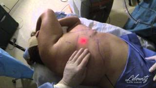 preview picture of video 'Liposuction Breast in Huntington, Long Island NY by Plastic Surgeon Dr. Lebowitz'