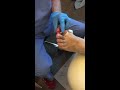 Ingrown toenail procedure. Podiatry office- Scottsdale, AZ.