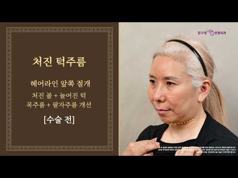  유형별 주름성형 10년 전으로 돌아가자