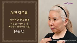 유형별 주름성형 10년 전으로