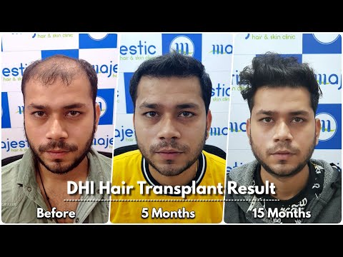 Hair Transplant in Delhi, Best hair Transplant Clinic in Delhi - Majestic Hair And Skin Clinic
