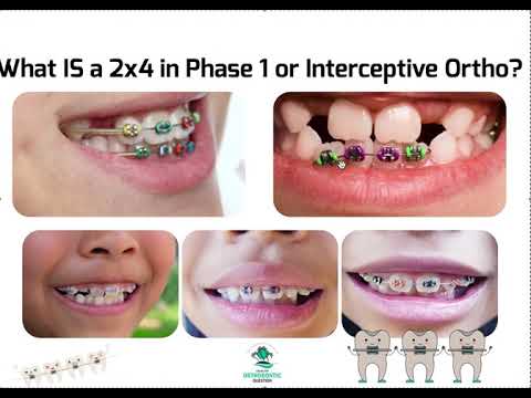 What is a 2x4 in Interceptive Ortho? Phase 1 Braces Explained