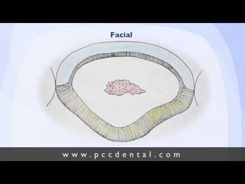 Ask Gordon: tooth preparations for veneers