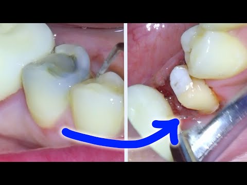 Full Dental Crown Procedure - After a Root Canal On a Molar