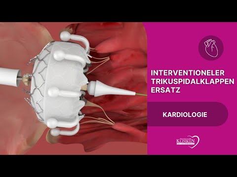Interventional tricuspid valve replacement - Modern therapy for complex valve diseases