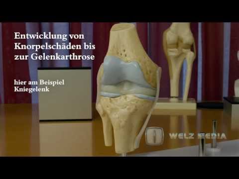 Als Klumpen auf die Gelenke zu behandeln Ñ € ÐμÐ ° Ð ± dd »Ð¸Ñ, Ð ° Ñ † Ð ± оРDn» ÑŒÐ½Ð¸Ñ † Ð ° Ñ ÑƒÑ Ñ, Ð ° вов d² Ð¼Ð¾Ñ ÐºÐ²Ðμ