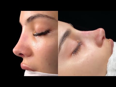 extreme nose & nasal bone reconstruction ୨୧ 💉 ⋆.˚ 1x experimental