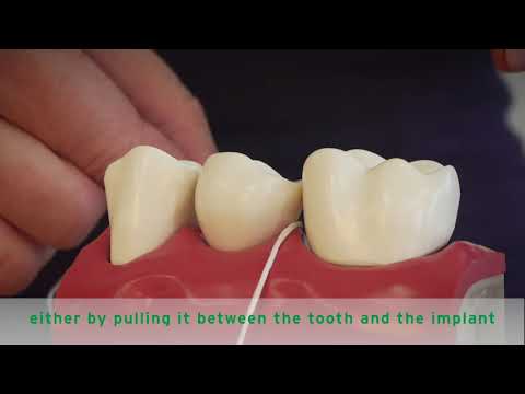 HOW TO FLOSS IMPLANTS