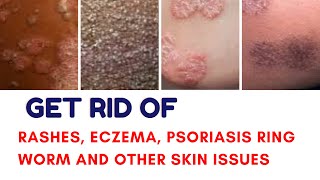 How to get rid of skin Rashes, EcZema, psOriasis , Ring worm and other skin issues.