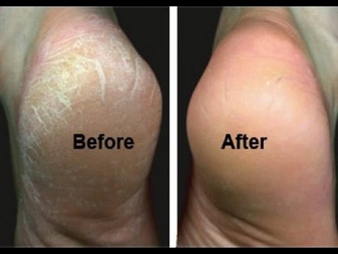 Maaari ko bang gamitin ang pagtingkayad alisin cellulite Diyeta sa mawala timbang ng almusal