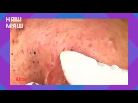 Давим ОГРОМНЫЕ ЖИРНЫЕ черные точки на лице / Большие прыщи