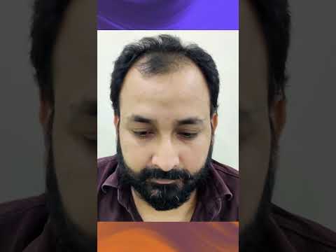 Happy Clients Reviews About Fue Hair Transplant in Delhi- Panacea Global 