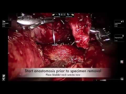 Handling Difficult Anastomosis During Robotic Prostatectomy