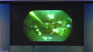 Video of management of Diabetic Retinal detachment in ASRS AIOC symposium ( Invited speaker )