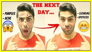 How To Get Rid Of Pimples OVERNIGHT - GET RID OF ACNE FAST!!
