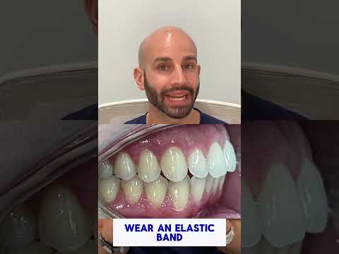 Invisalign And Elastic Bands To Fix Overbite