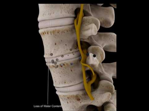 Recensioni della colonna vertebrale Laser, trattamenti laser Forte dolore alla colonna cervicale verso destra