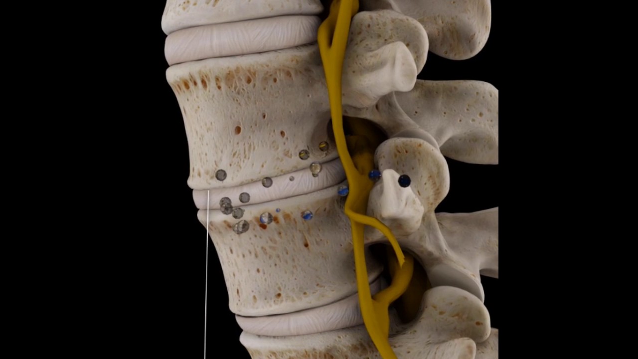 Watch Degeneracion disco Lumbar Now Degeneracion disco Lumbar