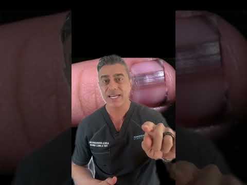 What your nails say about your health? - Dark Lined Nails