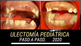ULECTOMÍA PEDIÁTRICA PASO A PASO. 2020.