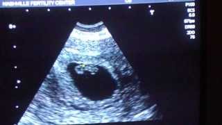 7 Week and 1 Day Ultrasound