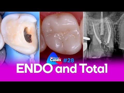 Leczenie endodontyczne i odbudowa zęba - przypadek kliniczny