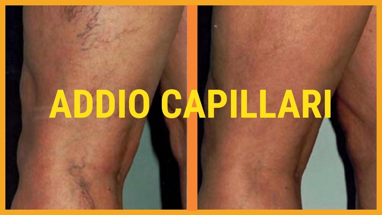 ♡ Come TOGLIERE I CAPILLARI sulle gambe ♡