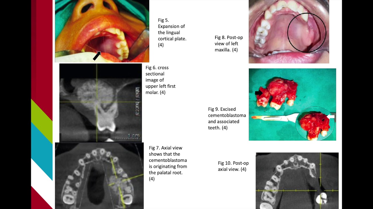 Cementoblastoma - YouTube