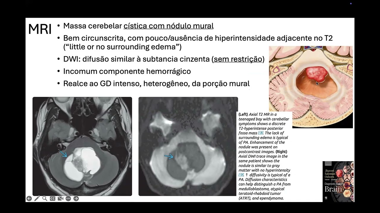Tumores Pediátricos Infratentoriais
