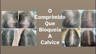 COMPRIMIDO PARA ACABAR COM QUEDA CAPILAR, VITAMINAS PARA ENGROSSAR OS FIOS TRATAMENTO PARA ALOPECIA