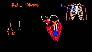 Systolic murmurs, diastolic murmurs, and extra heart sounds   Part 1