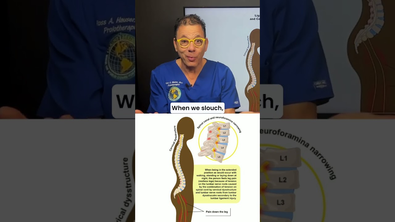 Lumbar radiculopathy caused by low back instability. #prolotherapy #sciatica #pinchednerve
