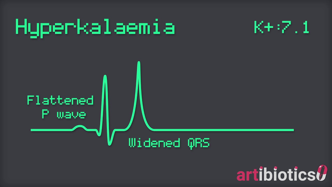Hyperkalaemia: ECG changes animated