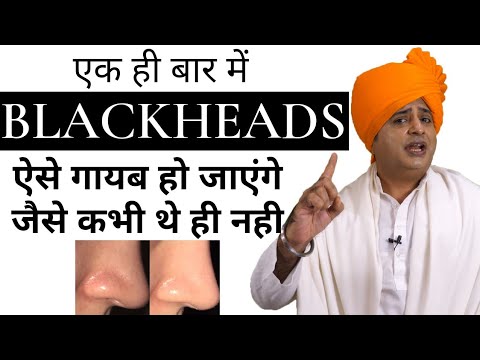 Get Rid of Blackheads to eliminate Blackheads from the roots || Sanyasi Ayurveda ||